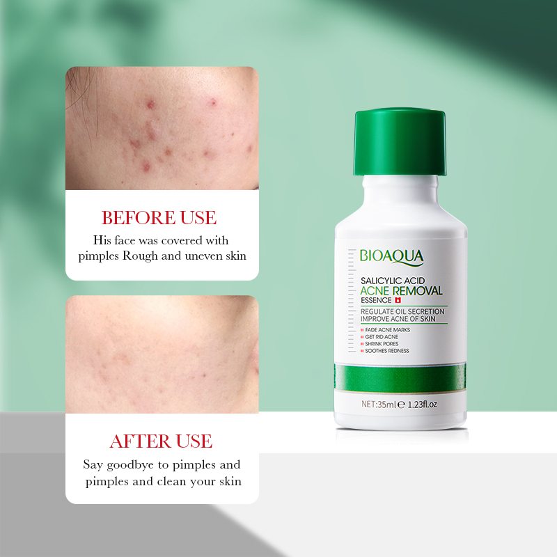 35ml BIOAOUA Salicylic Acid An - Salicylic Acid Blackhead Remover review and price